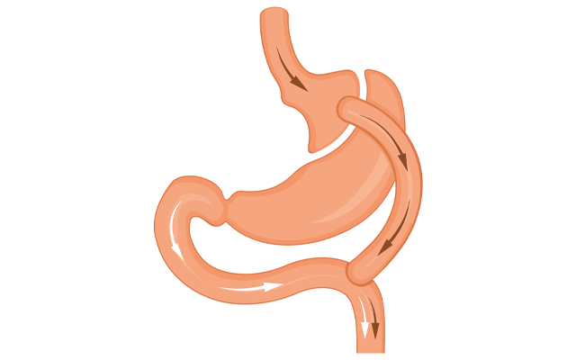 Exploring Different Types of Gastric Bypass Surgery
