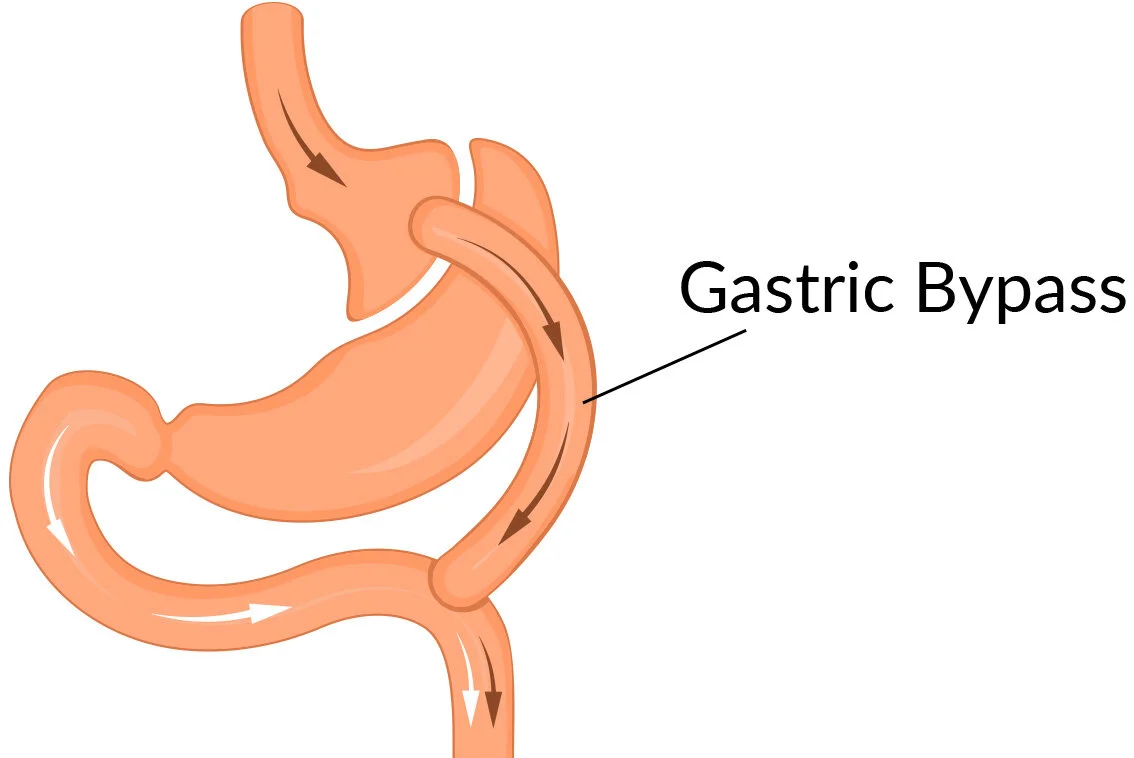 Understanding Gastric Bypass Surgery: A Comprehensive Guide